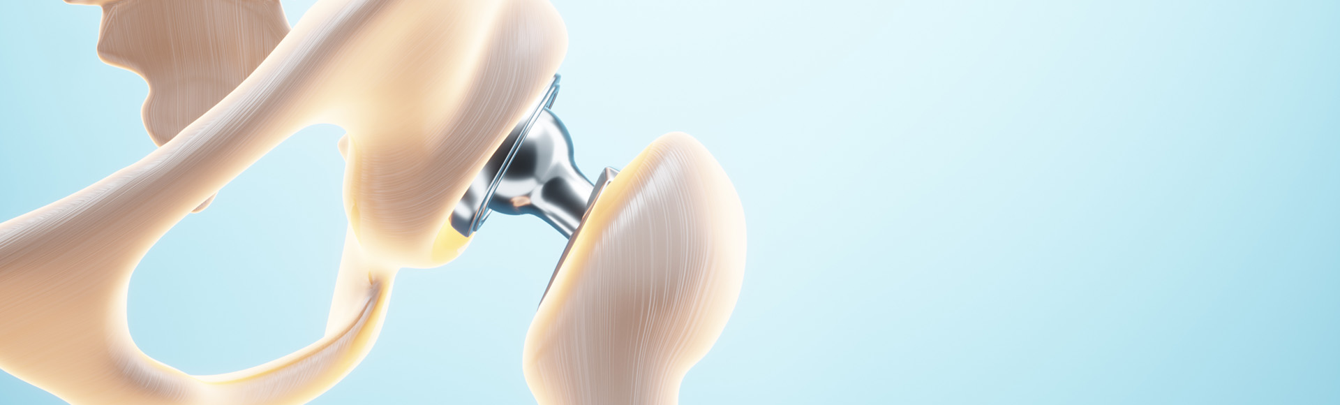 Künstliches Hüftgelenk: Mögliche Behandlung von Arthrose zur Schmerzreduktion.
