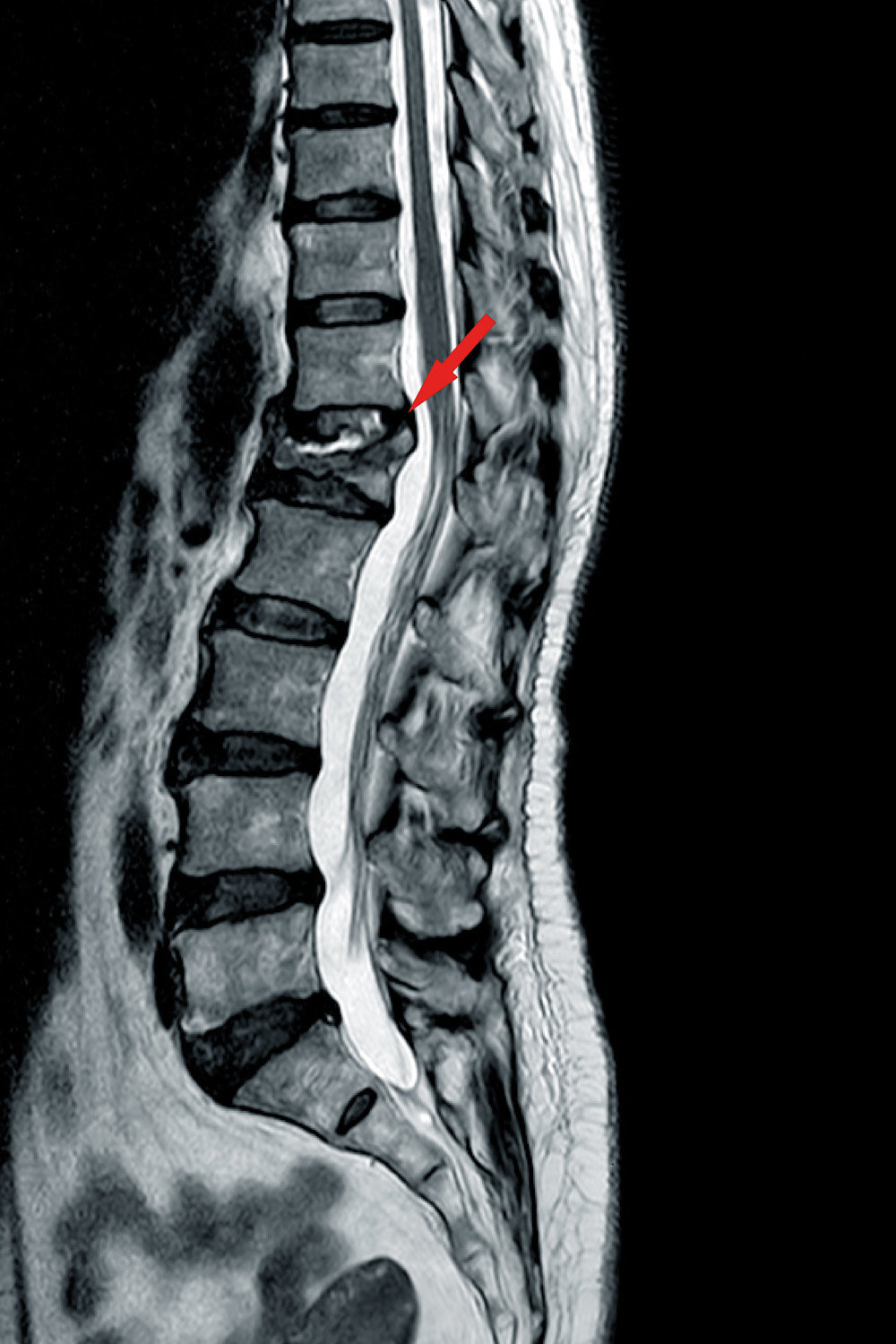 MRT der Lendenwirbelsäule mit markiertem Bandscheibenvorfall