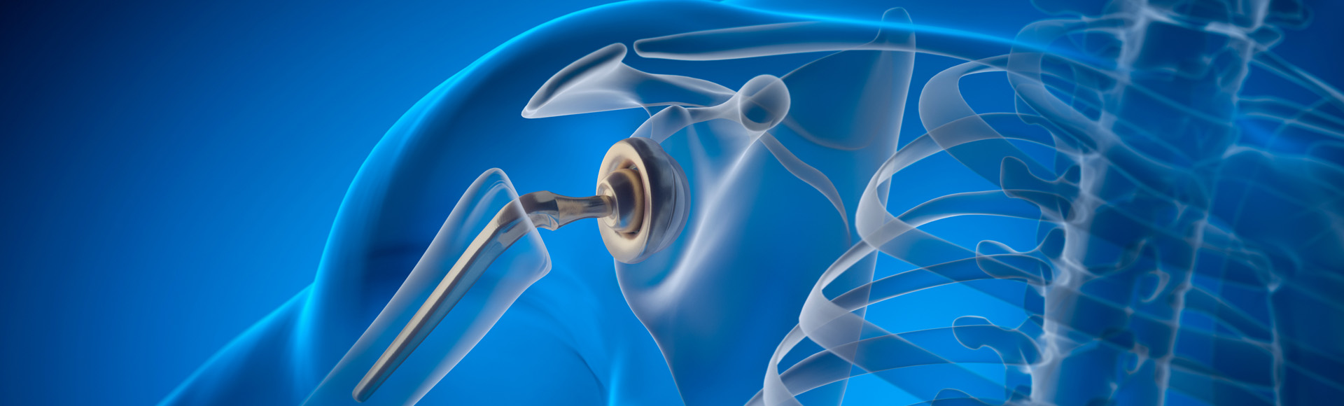 3D-Visualisierung Schulterprothese bei schwerer Humeruskopffraktur
