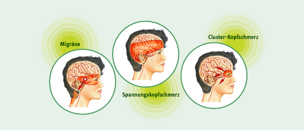 Grafik zu Migräne, Spannungs- und Clusterkopfschmerz mit markierten Schmerzarealen