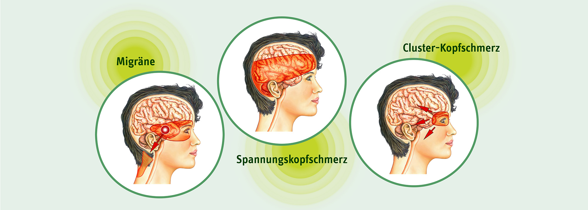 Grafik zu Migräne, Spannungs- & Clusterkopfschmerz mit markierten Schmerzarealen