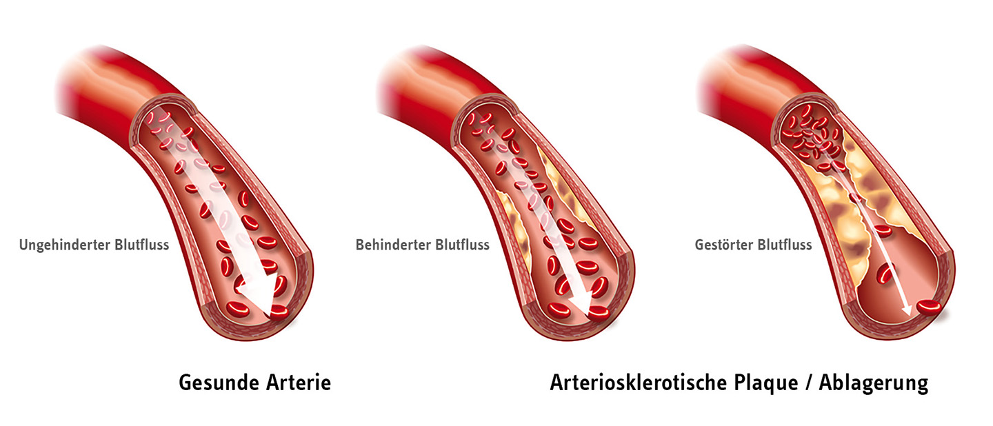 Grafik zu gesundem und gestörtem Blutfluss durch Arterienverkalkung