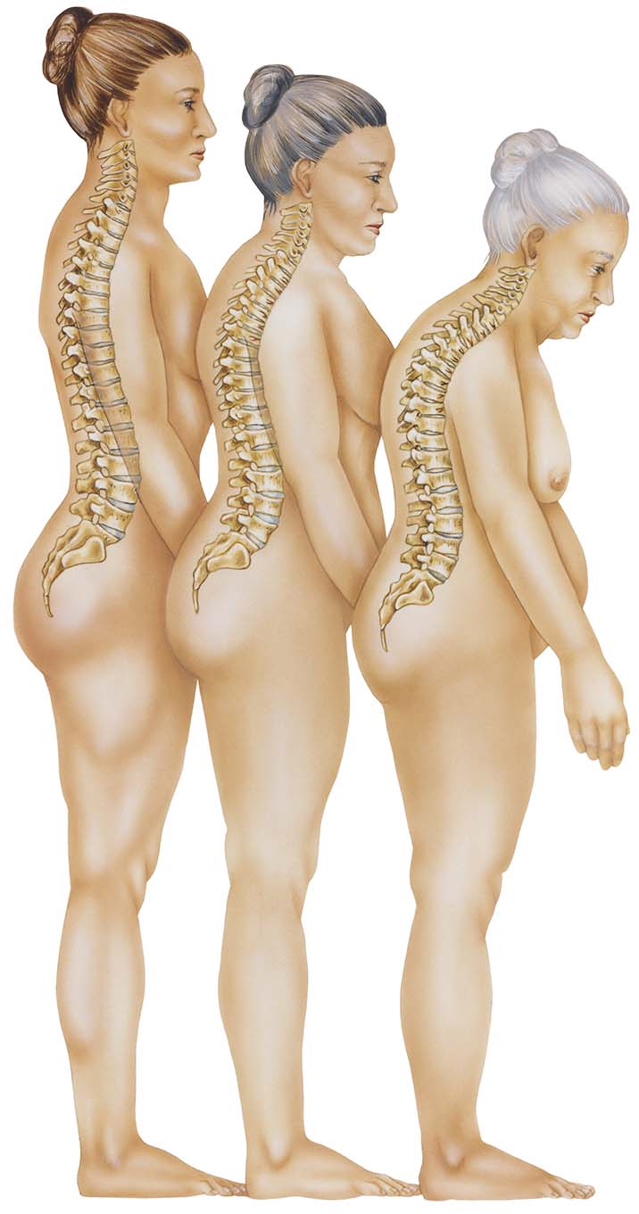 Osteoporose bei Frauen: Illustration fortschreitender Wirbelsäulenverkrümmung