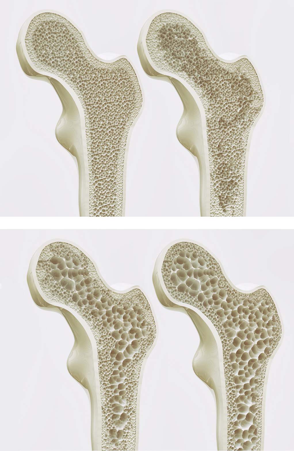 Vergleich von gesunden und osteoporotischen Knochenstrukturen: Oben dichter, gesunder Knochen; unten poröser Knochen mit Osteoporose. Symptome der Osteoporose sind verringerte Knochendichte und erhöhte Frakturgefahr.
