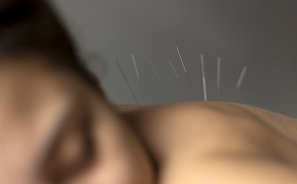 Akupunktur im ZAR Ottobrunn - jetzt für Reha & mehr in Ottobrunn entscheiden!