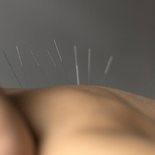 Akupunktur im ZAR Ottobrunn - jetzt für Reha & mehr in Ottobrunn entscheiden!